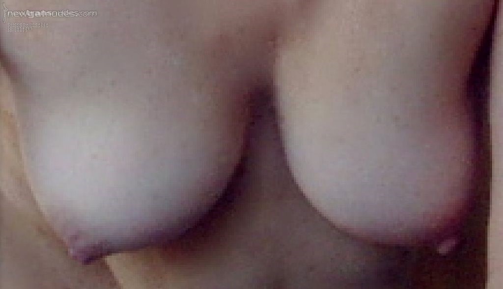 my boobs after my operation